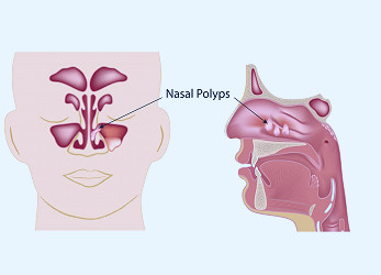 What are Nasal Polyps? (Signs, Symptoms, and Treatment Options)